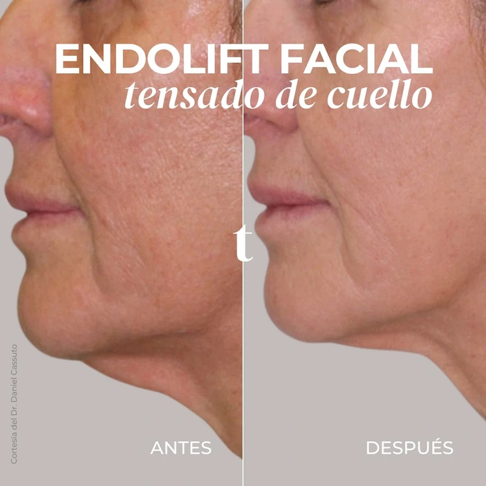 endolift-facial-cuello-antes-despues