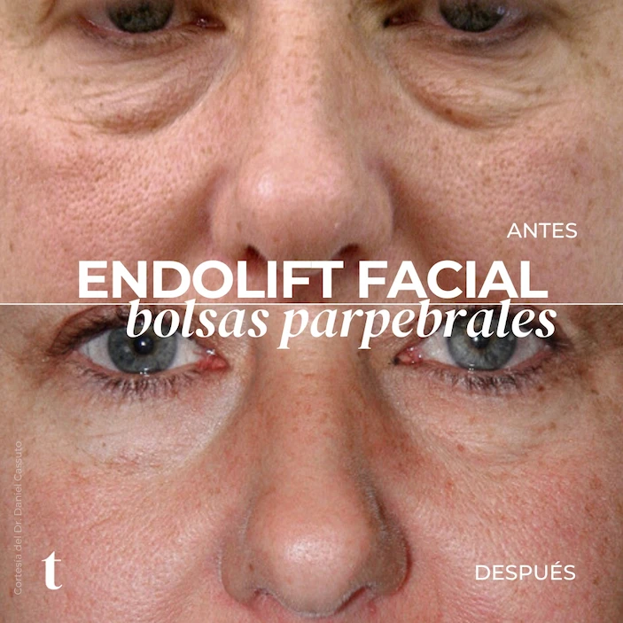 endolift-facial-ojeras-antes-despues