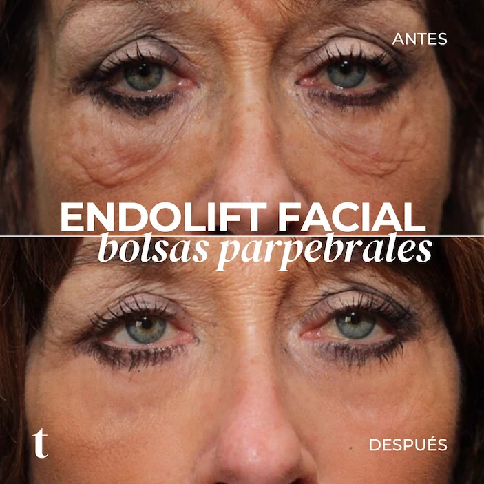 endolift-facil-bolsas-antes-despues