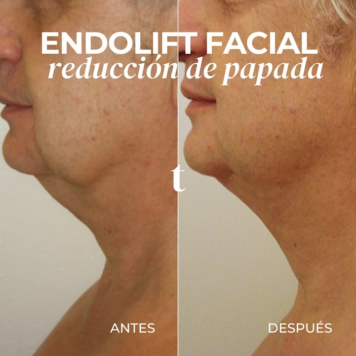 lipolifting-facial-papada-antes-despues