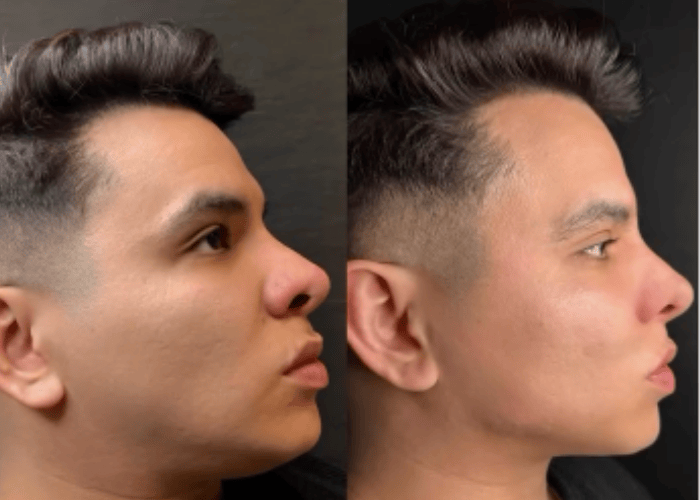 Antes y despues Fullface