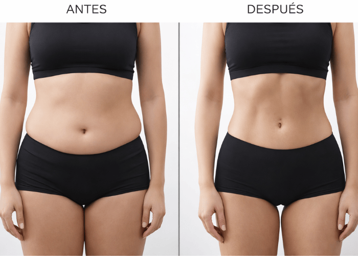 Endolift antes y despues
